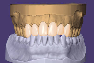 sprintray-exocad-digital-smile-design-wax-up.jpg