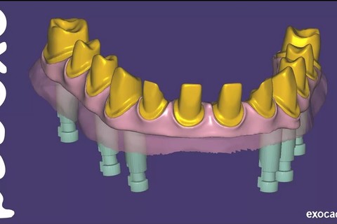 Exocad BASE
