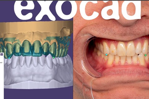 Exocad PRO